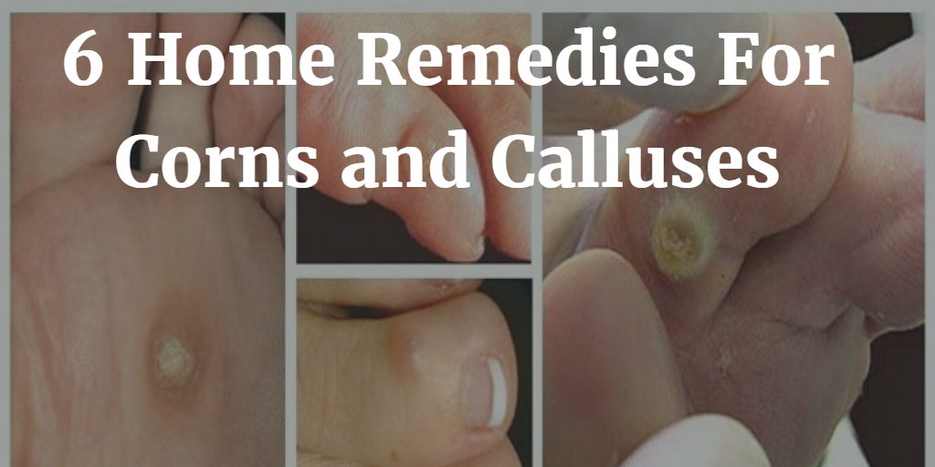 6 Best Home Remedies For Corns and Calluses Which Actually Work