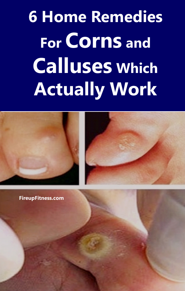 6 Home Remedies For Corns and Calluses Which Actually Work