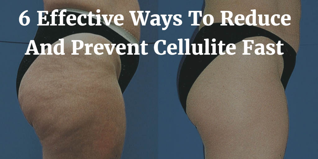 6 Effective Ways To Reduce And Prevent Cellulite Fast