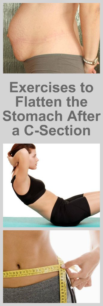 The Best Exercises to Flatten the Stomach After a C-Section
