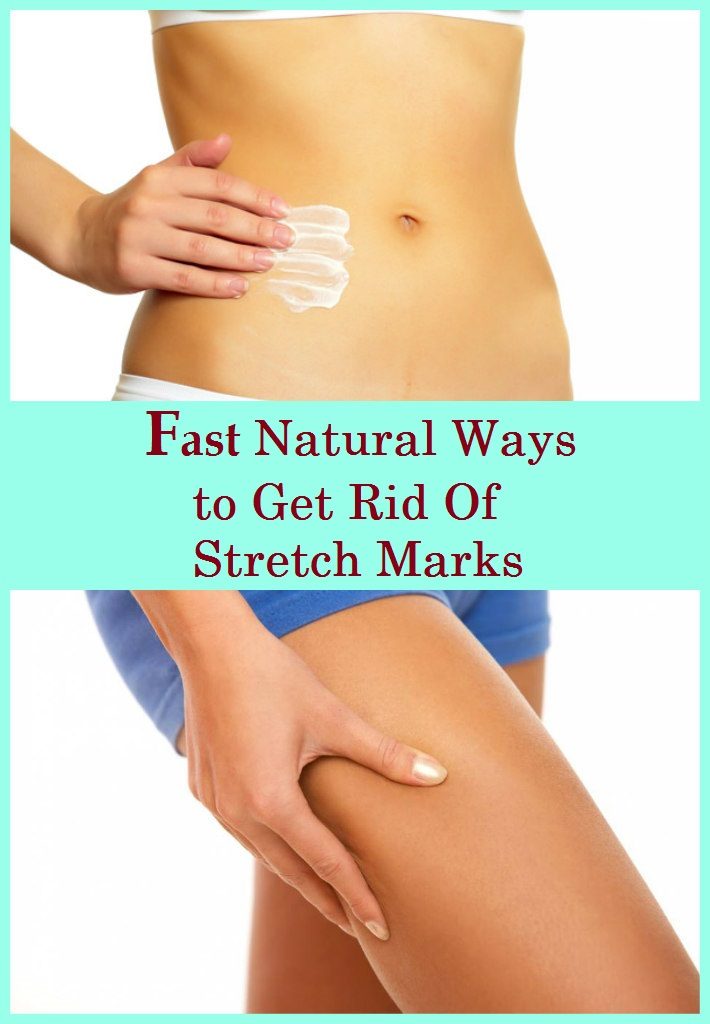 fast-natural-ways-to-get-rid-of-stretch-marks-1