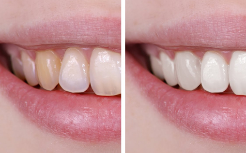 5 Steps to Whiten Your Teeth