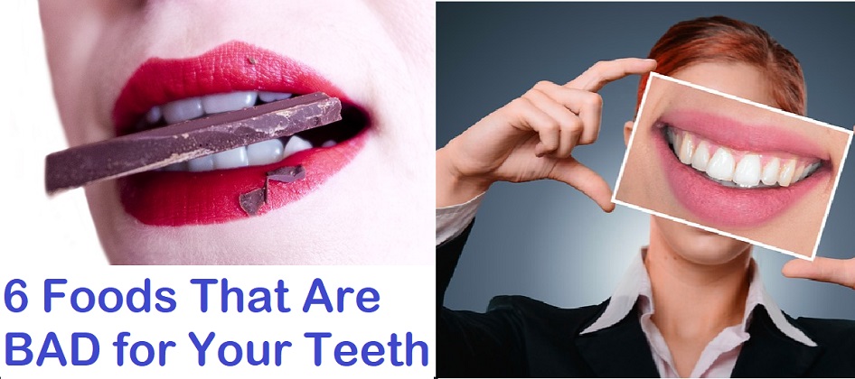 6 Foods That are Not Good for Your Teeth